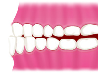 あなたの歯並びはどれ 治療について 松戸駅の矯正歯科 歯の矯正 歯列矯正なら秋山矯正歯科